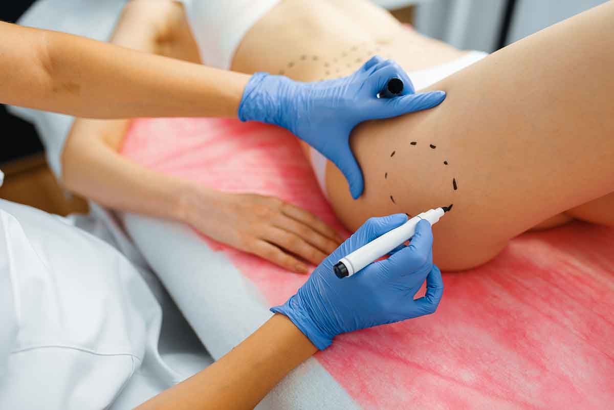 Liposuction and liposculpting